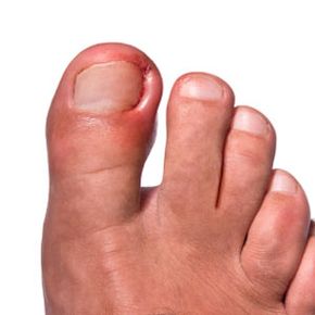 Ingrown nail on man's foot.