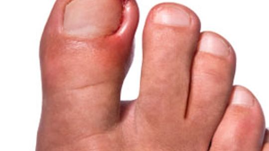 How to Treat an Ingrown Nail