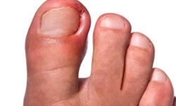 Ingrown nail on man's foot.