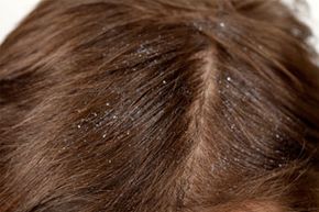 Dandruff is a common, usually harmless problem, and there are several possible causes for these white flakes. See more pictures of personal hygiene practices.