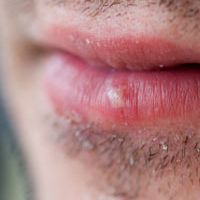 How To Treat Your Sunburned Lips? Symptoms, Risks, And More