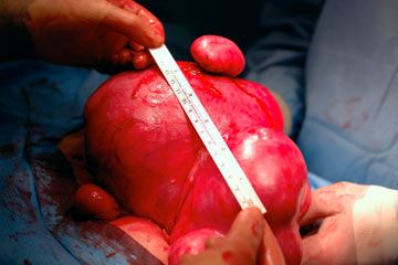 Surgical removal of an extremely diseased uterus, with numerous large fibroid tumors