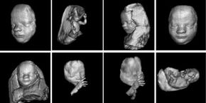 3-D ultrasound images