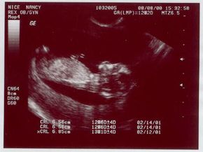 Ultrasound image of a growing fetus (approximately 12 weeks old) inside a mother's uterus. This is a side view of the baby, showing (right to left) the head, neck, torso and legs.