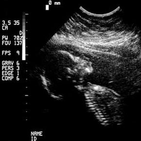 Ultrasonic waves helped produce this two-dimensional image of a developing fetus.“border=