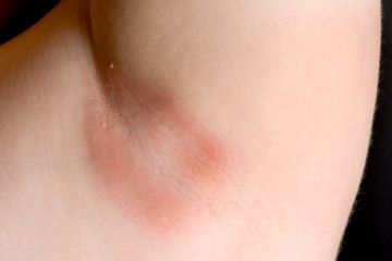 bacterial infection armpit lump