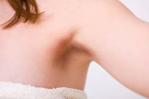 Discoloration of woman's underarm skin.