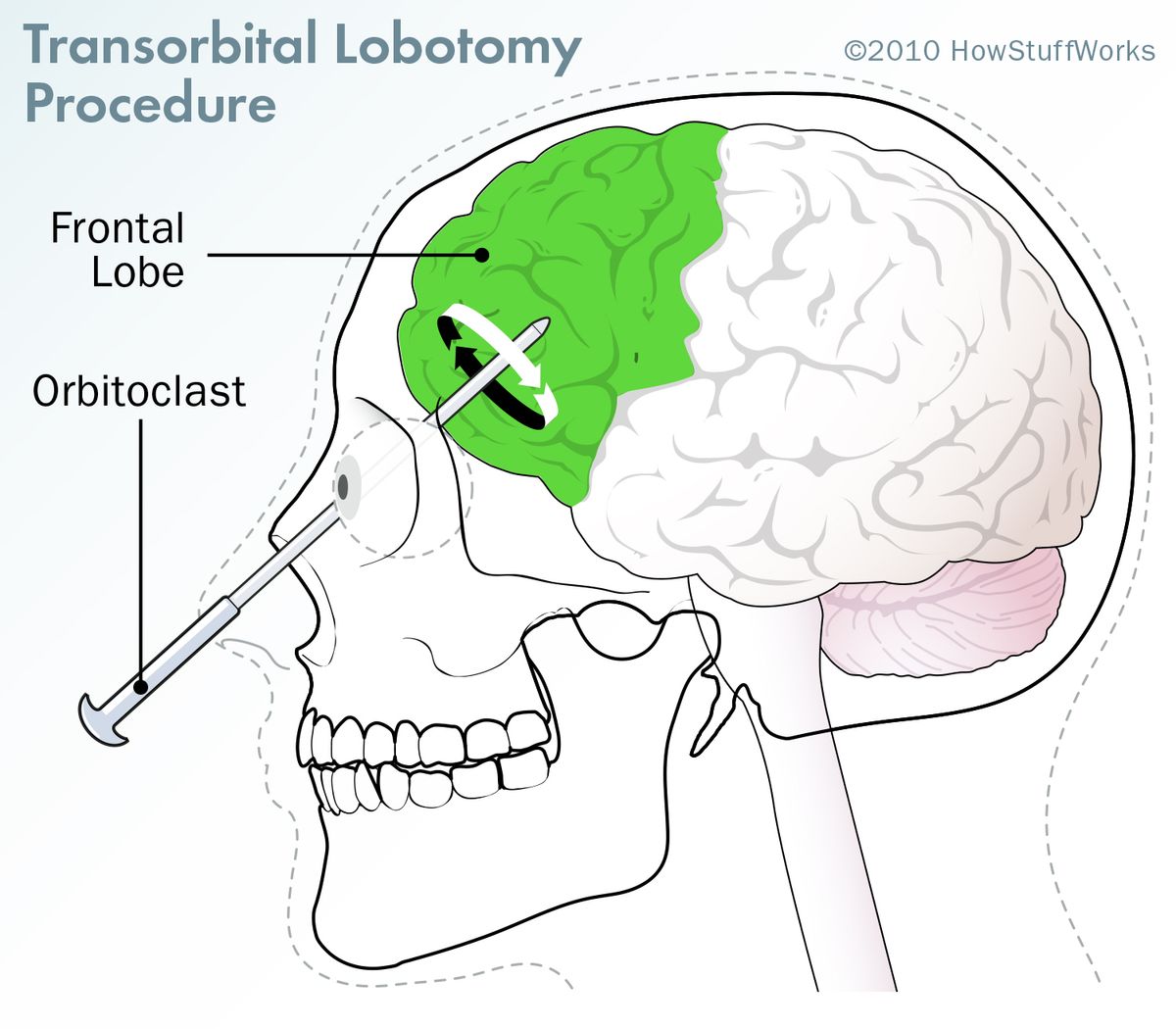 lobotomy before and after brain