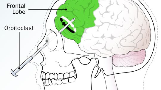 How Lobotomies Work