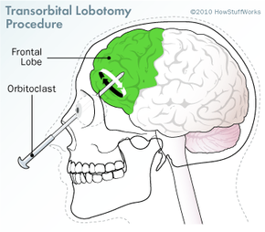 transorbital lobotomy procedure