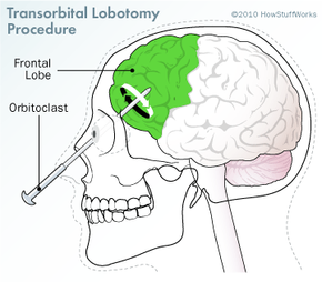 transorbital叶切断术过程”width=