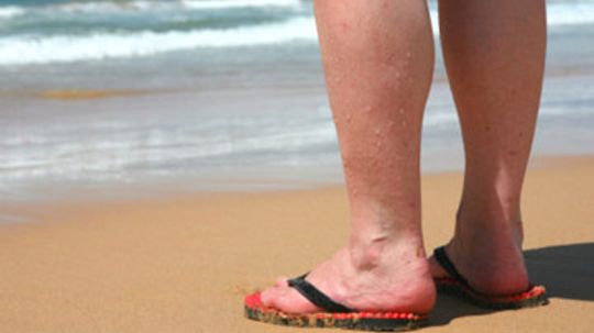 Varicose Veins Causes and Treatments