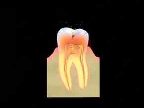 Watch this video explaining what an abscessed tooth is and when treatment is necessary.