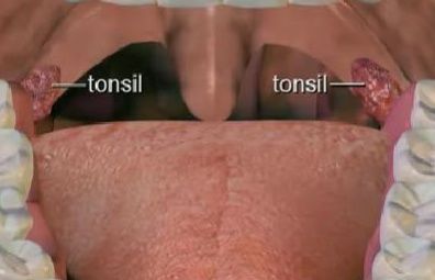 Human Atlas: Tonsilitis