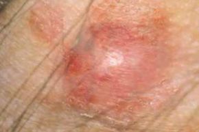Be on the look out for a firm red lump, a bloody or crusty lump, or a red spot that is rough, dry or scaly.