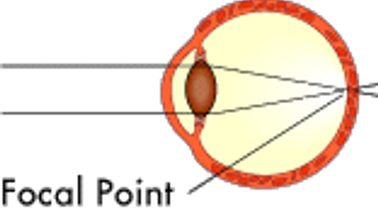 How Refractive Vision Problems Work