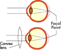 图3:如果你是远视眼，图像在到达视网膜之前不会聚焦(上)。凸透镜可以使焦点向前(底部)。＂border=