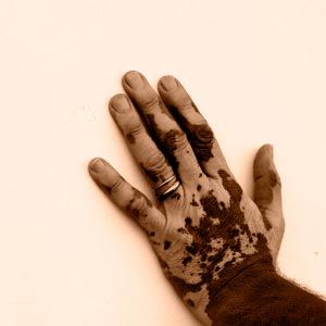 Man's hand affected by vitiligo, or depigmentation of skin.