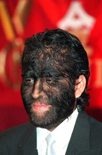 Fajardo Aceves Jesus Manuel, from Mexico, who has congenital hypertrichosis.