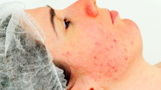 What causes red blotches on the face?