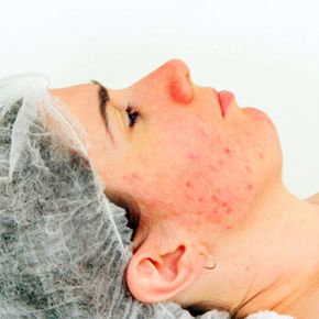 Young woman with Acne Scars