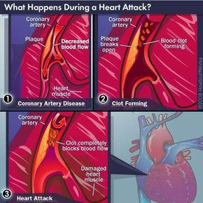 The three steps often responsible for heart attacks
