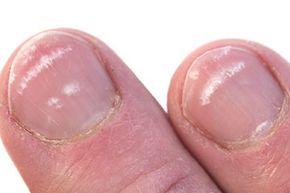 The occasional white spot on a nail typically isn't a clue to anything more than a bit of nail trauma.
