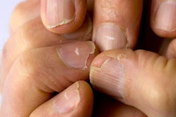 White spots on unhealthy fingernails.