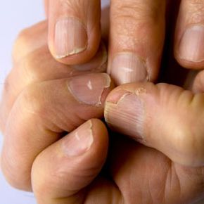 White spots on unhealthy fingernails.