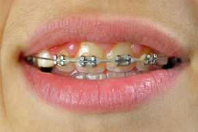 Feeling unattractive and self-conscious with your braces? Well whitening your teeth before the braces come off will likely do more harm than good.