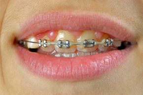 Braces Band Colors To Make Teeth Look Whiter