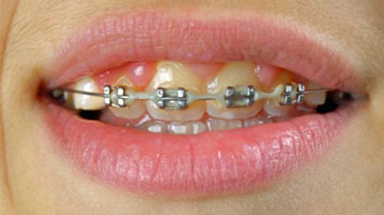 How to Whiten Teeth with Braces