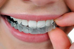 You shouldn't consider wearing invisible, removable appliances over any type of whitening products without consulting with your dentist, if at all.
