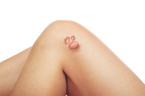 Close-up photo of the human knee on a white background