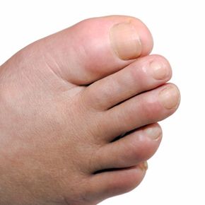 The calling card of gout: the swollen big toe.