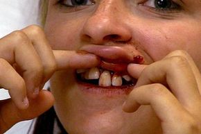 While on the golf course with her boyfriend, the patient receives a golf ball straight to the mouth.
