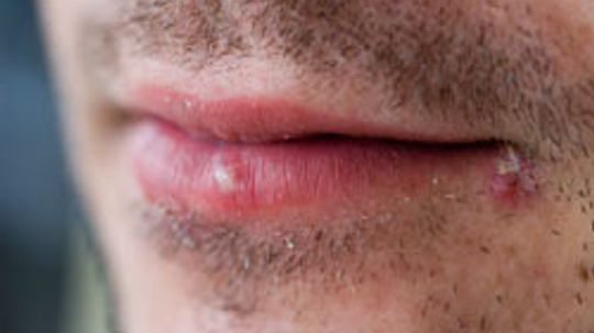 10 Causes and Treatments for Cold Sores