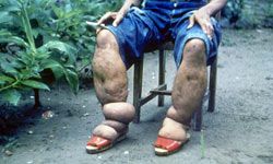 elephantiasis of the leg