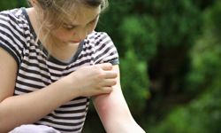 Girl scratching mosquito bite