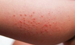 Symptoms of this disease include skin rashes.