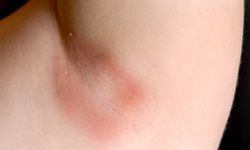 If you've ever noticed stinging, red dots when taking off clothing after being in the heat, you could be looking at a heat rash. See more skin problems pictures.