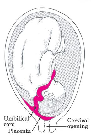 Placenta previa occurs when the placenta is low in the uterine cavity, covering the opening of the cervix. It can interfere with a normal delivery. See more pregnancy pictures.