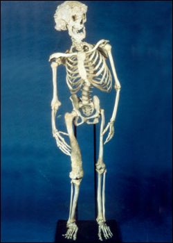 Joseph Merrick's skeleton, at the Royal London Hospital.
