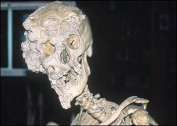 Skull and skeleton of Joseph Merrick.