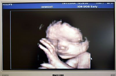 3d ultrasound of fetus