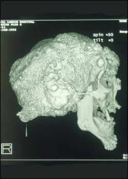 CT scan of Joseph Merrick's skull.