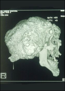 john merrick skull