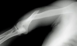 broken arm X-ray