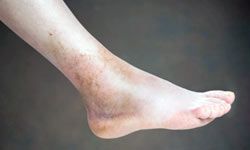 Both ankle fractures and sprains cause swelling and bruising, and can force you off your feet for long periods of time.