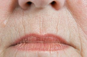 Lip lines are a natural sign of aging. They are most commonly found on smokers.